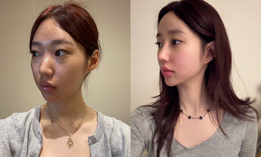 korean nose job before and after