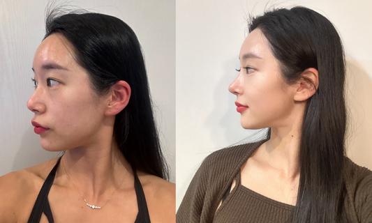 korean nose job price