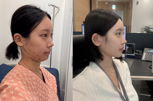 korean facelift